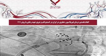 انجام نخستین درمان فیبریلاسیون دهلیزی در ایران در انستیتو قلب و عروق شهید رجایی با روش PFD